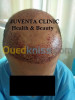 greffe de cheveux FUE , زراعة الشعر , 