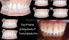 Aligner vos dents sans appareil odf