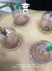 Formation en CUPPING THERAPIE ou Hidjama médicale