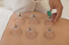 Hidjama (Cupping) médicale au feu et à l'huile, soins infirmiers 