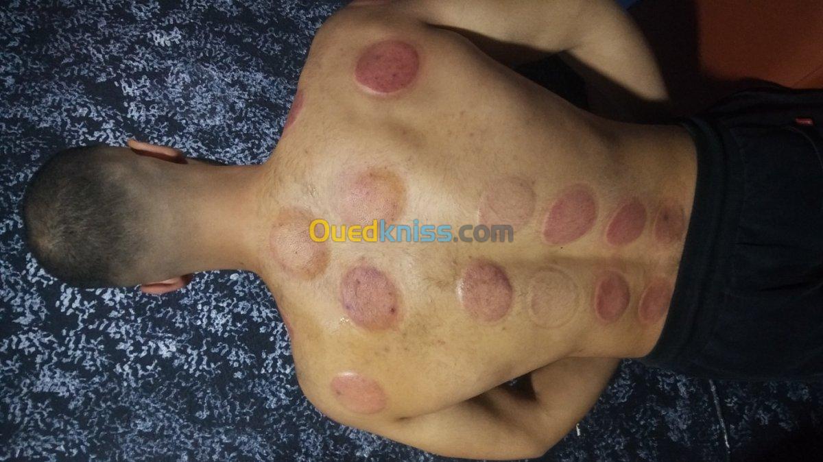 (Cupping thérapie)الحجامة و التدليك