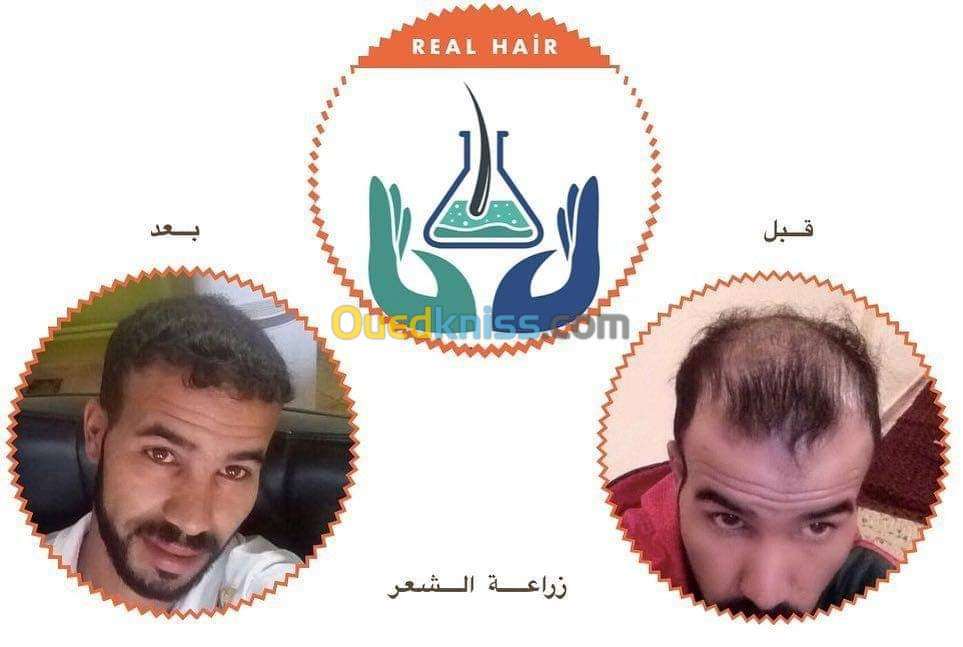 زراعة الشعر 