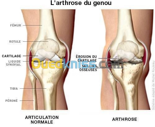 ARTHROSE RHUMATOLOGIE