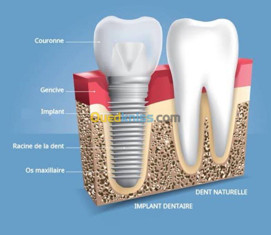  implant dentaire 