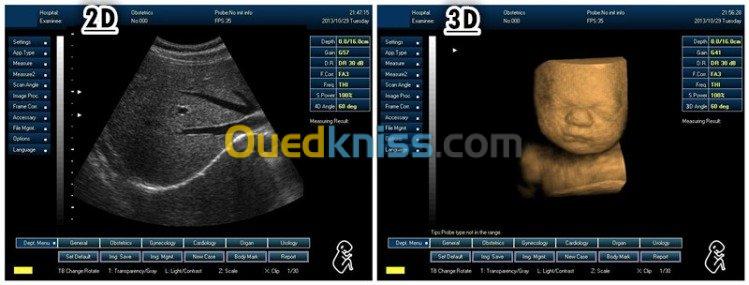 Echographie de diagnostic à ultrasons 