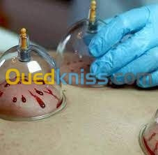 hijama حجامة