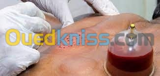 hijama حجامة