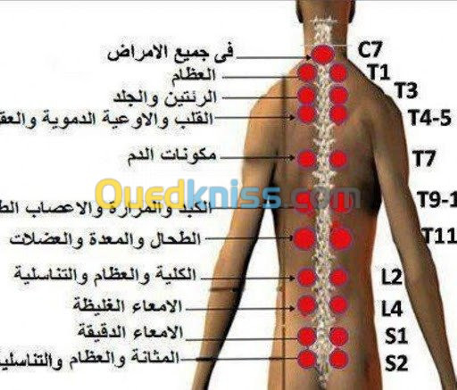 hijama حجامة