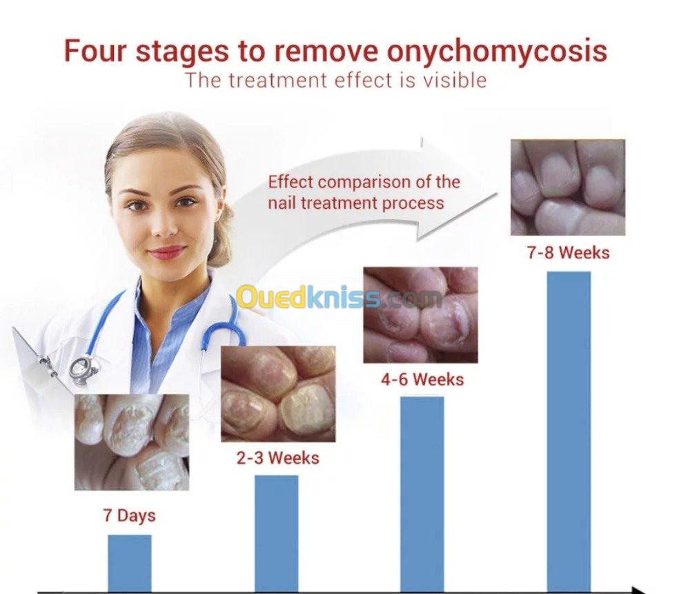 Éliminer la mycose des ongles