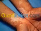 Traitement du Vitiligo علاج البهاق