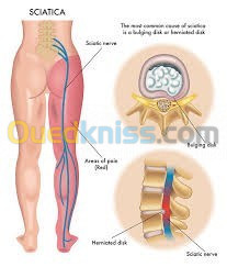 Hernie discale nerfs sciatique et autres 