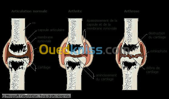 l'Arthrose et les problémes articulair