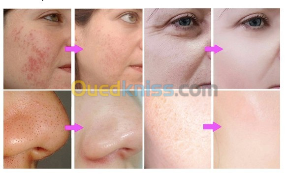 Appareil Hydrafacial 7 En1  Dermabrasion Soin du visage Soin de la peau 