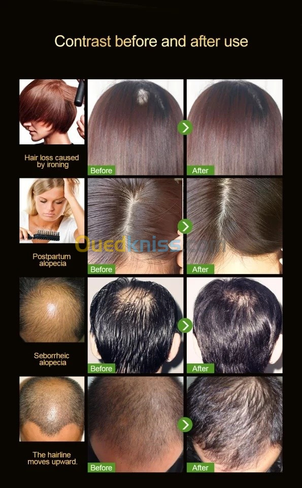 Anti chute cheveux solution miracle تساقط الشعر