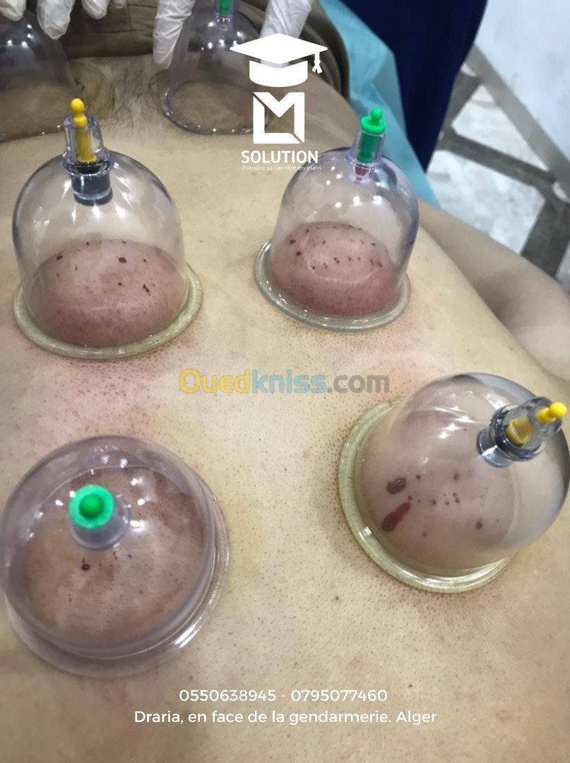 Formation en CUPPING THERAPIE ou Hidjama médicale