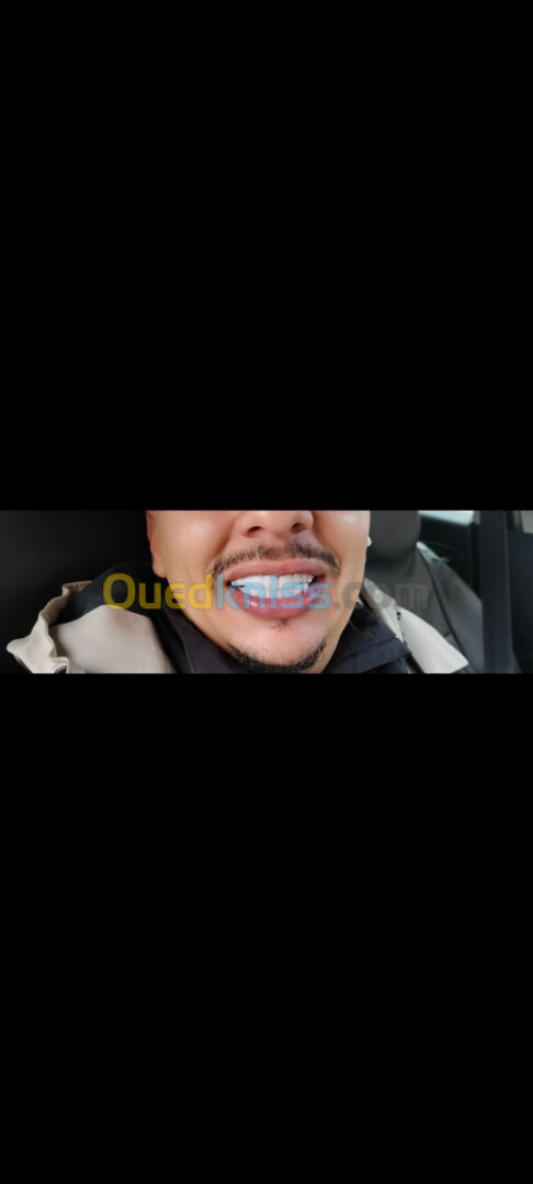 snap on smile sur mesure 