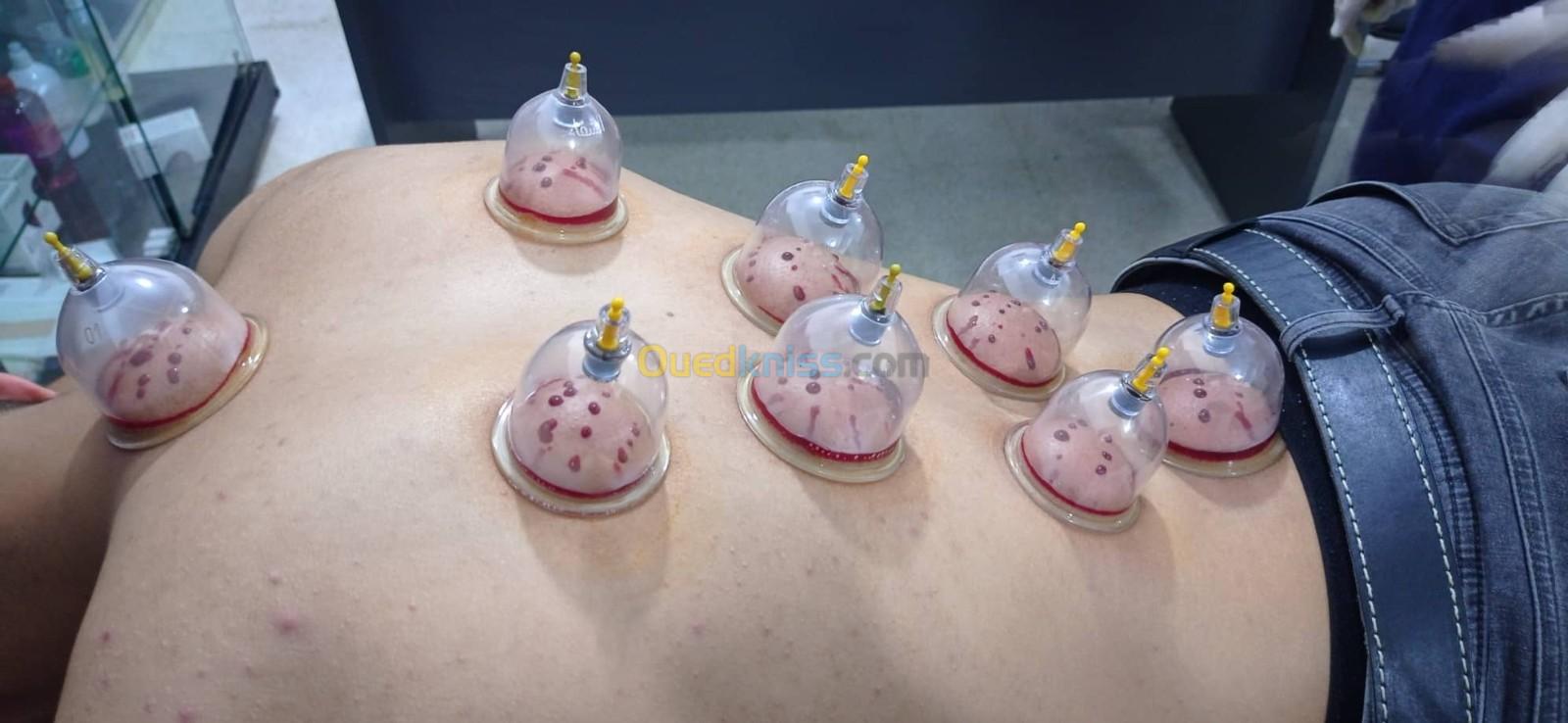 hijama a domicile حجامة