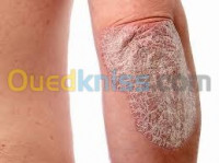 esthetique-beaute-psoriasis-bab-el-oued-alger-algerie