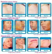 Epilation définitive  au laser...