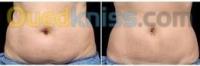 الجزائر-دالي-ابراهيم-تجميل-و-جمال-cryolipolyse