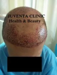 greffe de cheveux FUE , زراعة الشعر , 