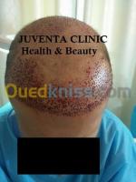 annaba-algerie-médecine-santé-greffe-de-cheveux-fue-زراعة-الشعر