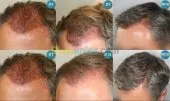 transplantation capillaire