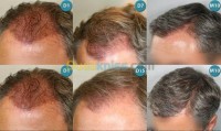 الجزائر-وسط-تجميل-و-جمال-transplantation-capillaire