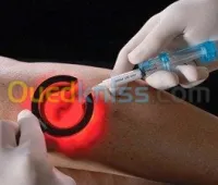 Traitement des varices sans chirurgie