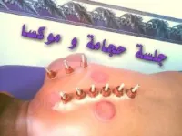 Hijama