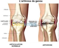الجزائر-شراقة-طب-و-صحة-arthrose-rhumatologie