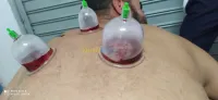 حجامة العلاجية و الوقائية  Cupping the
