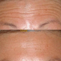 esthetique-beaute-botox-filer-microneedling-et-mesother-bab-el-oued-alger-algerie