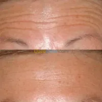  Botox filer microneedling et mesother
