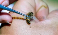 الحجامة الطبية نساء ورجال واطفال