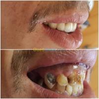 البليدة-بني-تامو-الجزائر-طب-و-صحة-odf-hollywood-smile-implantation