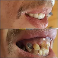ODf / Hollywood smile /Implantation 