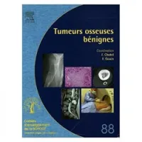 Tumeurs osseuses bégnines