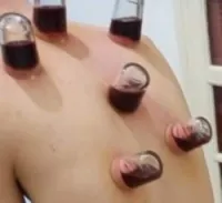 الحجامة الوقائية والعلاجية (رجال) 