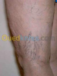 الجزائر-سعيد-حمدين-تجميل-و-جمال-varices-de-jambe-nouvelles-therapies