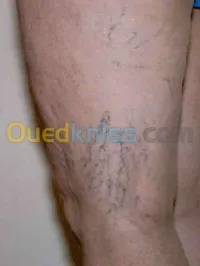 Varices de jambe - Nouvelles Therapies