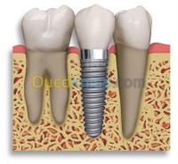 الجزائر-بن-عكنون-خدمات-dentiste