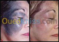 esthetique-beaute-taches-brune-laser-علاج-البقع-البنية-bab-el-oued-alger-algerie