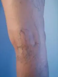 les traitements des varices