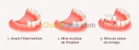Implant dentaire et chirurgie buccale