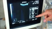 Echographe ALOKA SSD-1000