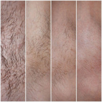 corporelle-epilation-definitive-au-laser-تخلص-من-الشعر-الزائد-نهائيا-said-hamdine-alger-algerie