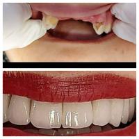طب-و-صحة-reduction-couronnes-dentaires-الجزائر-وسط