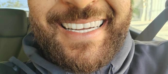 Snap on smile sur mesure (l'original)