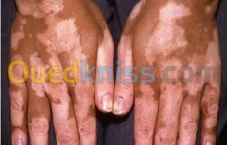 Traitement du Vitiligo علاج البهاق